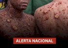 Ministério da Saúde emite alerta urgente após aumento de casos de Mpox no Brasil