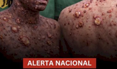 Ministério da Saúde emite alerta urgente após aumento de casos de Mpox no Brasil